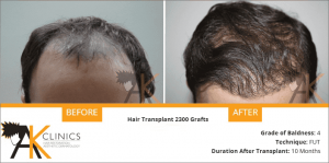 india-fut-strip-hair-transplant-result-6