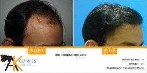 india-strip-hair-transplant-result-15