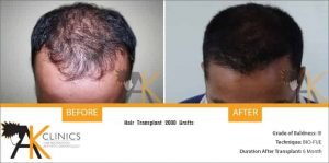new-delhi-bio-fue-hair-transplant-13
