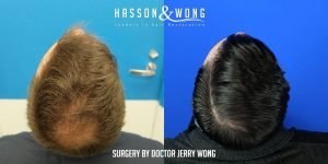 Dr Wong FUE hair transplant