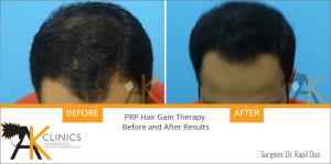 prp-hair-therapy-results-1