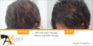 prp-hair-therapy-results-4