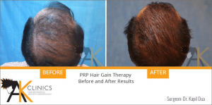 prp-hair-therapy-results-5