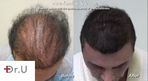 Top Hair Repair Patient Before 9000 Bht Grafts