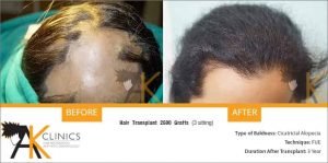 women-circatricial-alopecia-hair-transplant-result-1